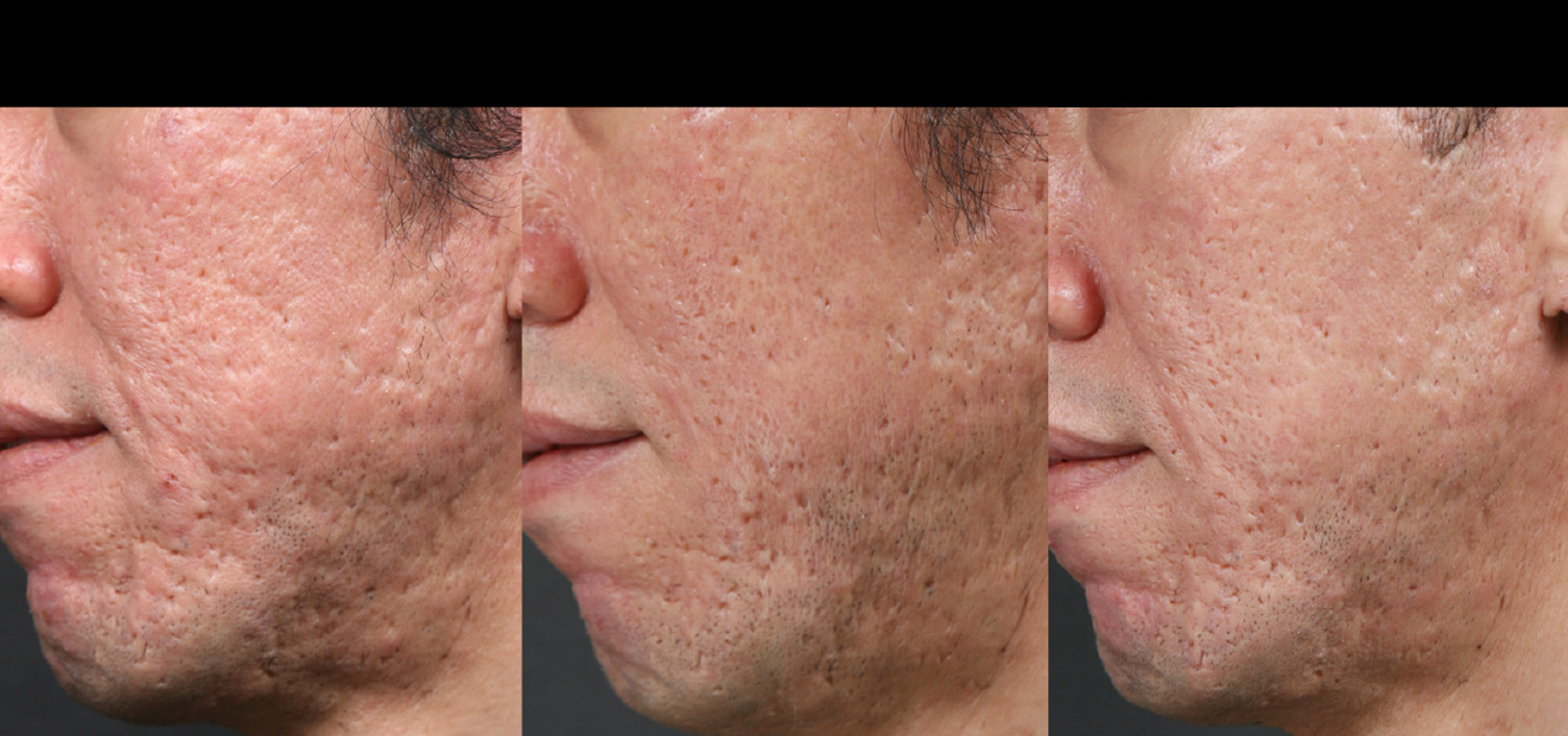 Facial treatment